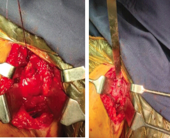 Figure 4: (a,b) Tunnel created between subscapularis and joint capsule, the conjoint tendon along with osteotomized coracoid process passed through the tunnel and fixed with 4-mm cc screw.