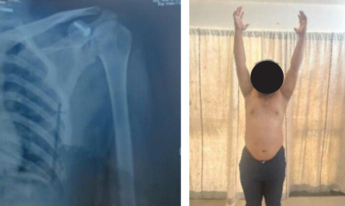 Figure 5: (a,b) Post-operative radiograph and clinical picture showing full range of motion.