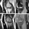 Is Cell-Free Collagen Matrix Effective in the Treatment of Large Cartilage Defects of Knee? Early Functional and Quantitative Magnetic Resonance Imaging Cartigram Assessment in Two Patients