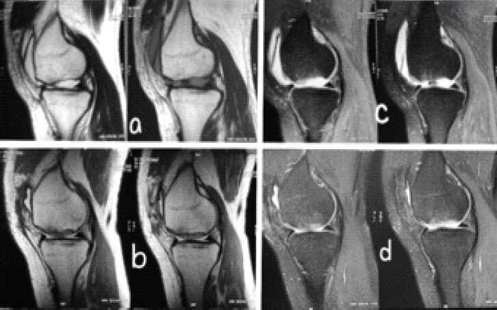 Figure 1: Pre-operative and post-operative conventional magnetic resonance imaging of the cartilage defect of case 1. (a) pre-operative T1 sagittal section, (b) post-operative T1 sagittal section, (c) Pre-operative T2 sagittal section, (d) post-operative T2 sagittal section.