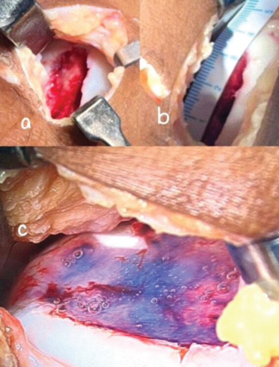 Figure 2: Intraoperative pictures of case 1: (a) cartilage defect after debridement, (b) defect size measurement, (c) repair of defect using cell free collagen matrix.
