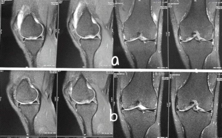 Figure 3: Pre-operative and post-operative conventional magnetic resonance imaging of case 2. (a) pre-operative T2 sagittal and coronal sections, (b) post-operative T2 sagittal and coronal sections.
