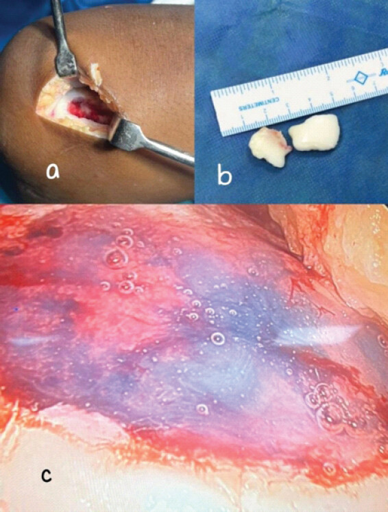 Figure 4: Intraoperative images of case 2: (a) cartilage defect after debridement, (b) removed loose bodies, (c) defect after repair using cell free collagen matrix.
