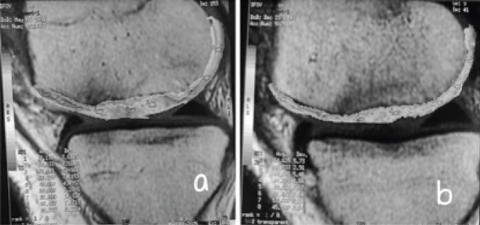 Figure 5: Cartigram at 6 months (T2 values are written within the image). (a) Cartigram of case 1, (b) Cartigram of case 2.