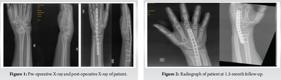 Comparative Analysis of Dorsal Distraction Plating Versus External ...