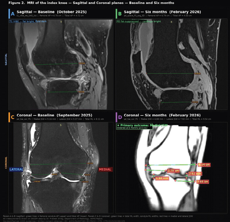 Figure 4: Representative MRI of the index knee at baseline and 6-month follow-up in sagittal (Panels A and B) and coronal (Panels C and D) planes with measurement lines showing morphometric and joint space width parameters. Panel A – Sagittal, baseline (October 2025): T1-weighted VIBE water excitation sagittal MRI (t1_vibe_we_SAG_iso) of the left knee at baseline. Fat is bright, and fluid is dark. Green measurement lines: femoral condyle AP = 6.70 cm (upper line, anterior to posterior condyle margin) and tibial AP = 4.72 cm (lower line, tibial plateau anterior to posterior margin), corresponding to morphometric data in Table 4. Panel B – Sagittal, 6 months (February 2026): Proton density fat-suppressed 3D sagittal MRI (pd_space_FS_sag_3D) of the same knee at 6 months. Fat suppression renders synovial fluid and articular cartilage hyperintense. Femoral condyle AP = 6.79 cm and tibial AP = 4.53 cm. Comparison with Panel A demonstrates improved articular cartilage signal consistency following lateral wedge insole intervention. Panel C – Coronal, baseline (September 2025): PD TSE fat-suppressed coronal MRI (pd_tse_cor_FS; 400 × 360 matrix). Measurement lines show total ML femoral width = 8.11 cm, medial condyle ML = 2.89 cm, lateral condyle ML = 3.35 cm, medial JSW = 5.16 mm, lateral JSW = 5.37 mm. Right knee in standard radiological orientation (R on image left = lateral; L on image right = medial). Lateral and medial compartments labeled for orientation. The illustrative case (participant K001, Study group, 53-year-old female) shows baseline medial JSW of 1.73 mm, which increased to 2.13 mm at 6 months, representing a change of +0.40 mm consistent with the cohort mean change reported in Table 2. Measurement methodology: All measurement lines drawn directly on DICOM data in RadiANT DICOM Viewer by Dr. Prateek Sihag, Department of Radiology, AIIMS Rajkot. All patient-identifying information removed per ICMR National Ethical Guidelines. Written informed consent obtained. IEC: AIIMS/RAJKOT/6th IEC/FB/02. JSW: Joint space width, AP: Antero-posterior, ML: Medio-lateral, MRI: Magnetic resonance imaging, VIBE: Volumetric interpolated breath-hold examination, PD: Proton density, TSE: Turbo spin echo, FS: Fat-suppressed, OA: Osteoarthritis, S: Superior, A: Anterior, P: Posterior, ★: Primary outcome variable.