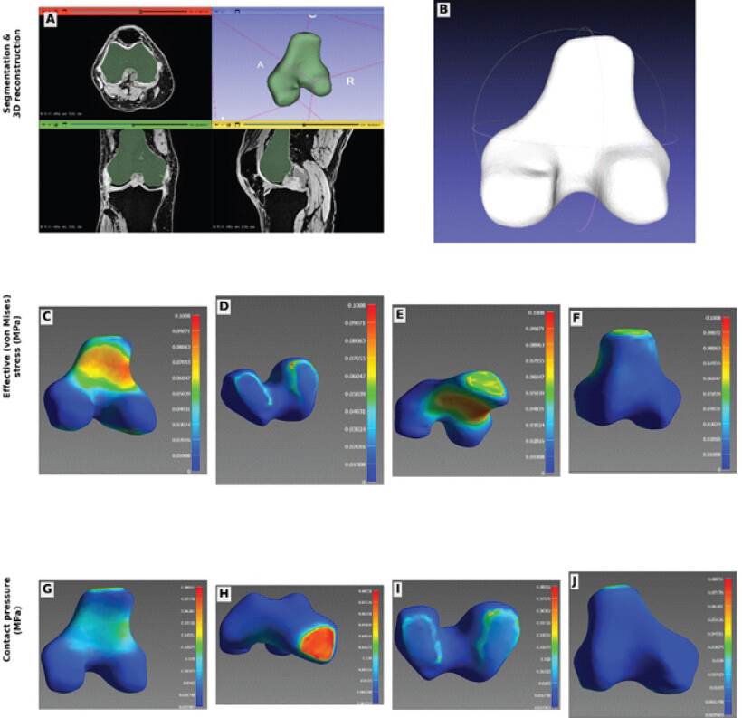 Figure 6: Representative subject-specific finite element analysis model of the distal femur. Representative subject-specific FEA model derived from MRI segmentation of the distal femur in one study participant with knee osteoarthritis. (a) Multi-planar MRI views (axial, coronal, sagittal) with the femoral cartilage/bone segmented (green overlay) and the corresponding 3D surface reconstruction (top right panel). (b) Smoothed 3D rendering of the segmented distal femur used as the geometry for finite element meshing. (c-f) Effective (von Mises) stress distribution, expressed in MPa, shown across four viewing angles of the same femoral model under simulated stance-phase gait loading conditions. (g-j) Corresponding contact pressure distribution (MPa) across the same four viewing angles. In all contour plots, color denotes the local magnitude of stress or pressure, increasing from blue (lowest) to red (highest), as indicated by the color scale adjacent to each panel. This model represents the first cohort of patients with complete baseline MRI datasets; full FEA results across baseline, 9-month, and 18-month time points, including comparison between study and control groups, will be reported in a companion publication. FEA: Finite element analysis, MPa: Megapascal, MRI: Magnetic resonance imaging. Data source: Department of Physics, Saurashtra University finite element analysis pipeline (Section 2.6), present study.