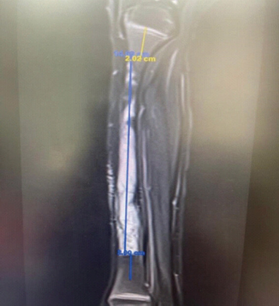 Figure 2: Pre-operative magnetic resonance imaging showing a permeative lesion involving the majority of the right tibial shaft.