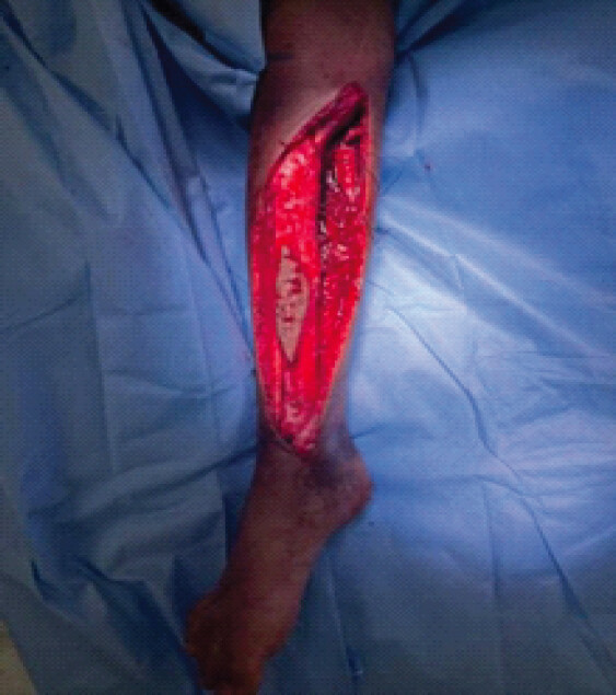 Figure 3: Intraoperative view following longitudinal incision and circumferential dissection of the tibia.