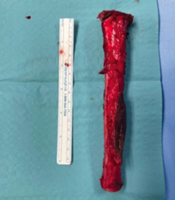 Figure 4: Resected tibia removed en bloc after proximal and distal osteotomies.