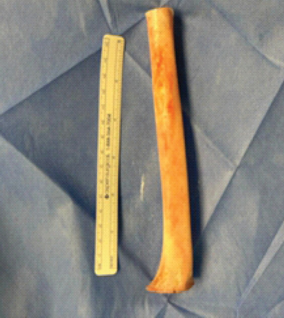 Figure 5: Resected tibia following meticulous removal of adherent soft tissue before extracorporeal irradiation.