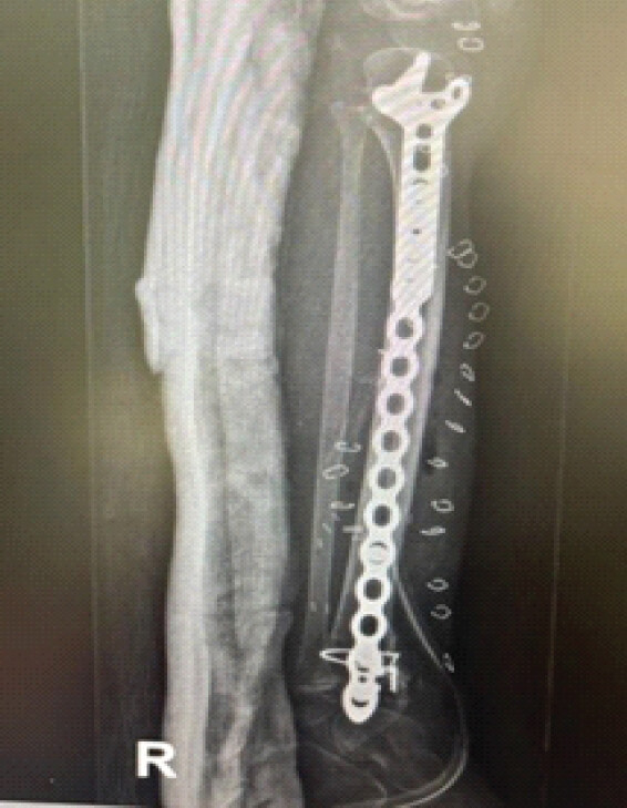 Figure 6: Post-operative radiograph of the right tibia demonstrating internal fixation and limb reconstruction.