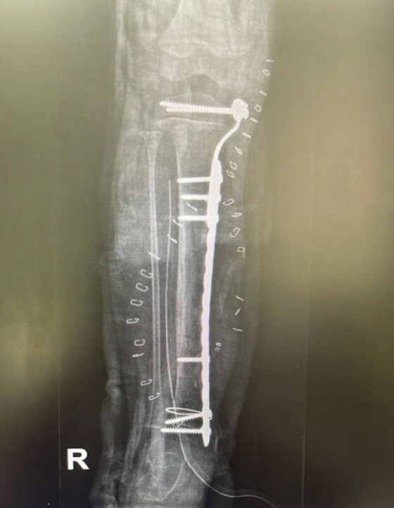 Figure 7: Follow-up radiograph showing maintained alignment and stable hardware position.