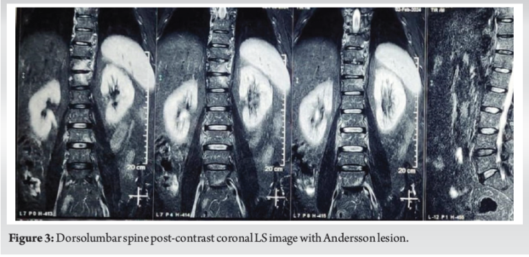 Recent Advances in Managing Ankylosing Spondylitis with Andersson ...