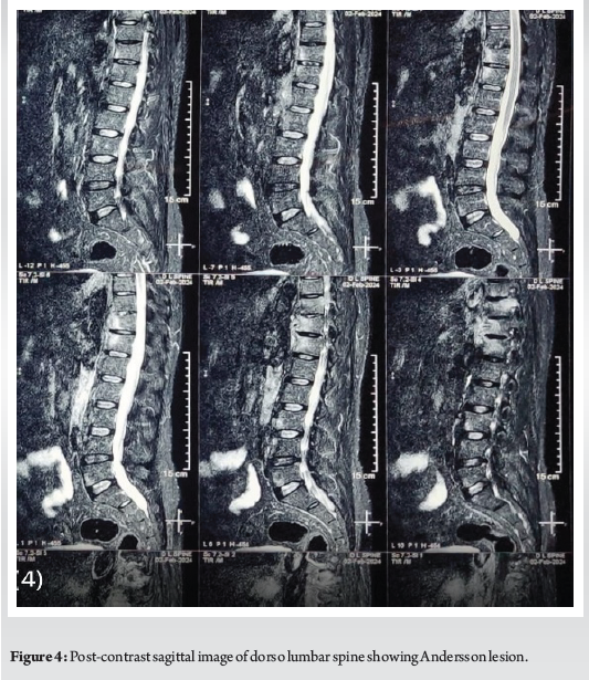 Recent Advances in Managing Ankylosing Spondylitis with Andersson ...