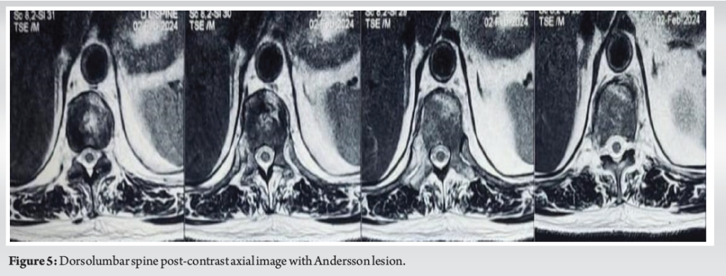 Recent Advances in Managing Ankylosing Spondylitis with Andersson ...