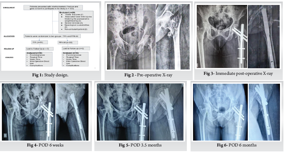 Nailing the Outcome: A Comparative Study of Proximal Femoral Nail Anti ...