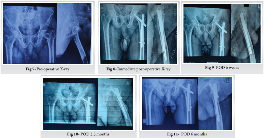 Nailing the Outcome: A Comparative Study of Proximal Femoral Nail Anti ...