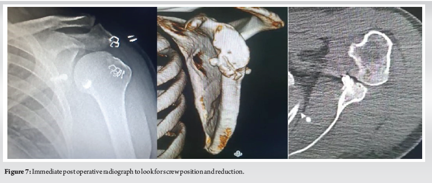 Arthroscopic Fixation of Acute Large Bony Bankart with Suture-assisted ...