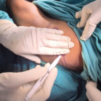 Figure 1: For surgeons with hand glove size >7, the anterior superior iliac spine is indicated with a skin marker. Consequently, using the width of the surgeon’s four medial fingers (from the index to the little finger), a point is marked on the iliac crest.
