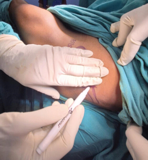Figure 1: For surgeons with hand glove size >7, the anterior superior iliac spine is indicated with a skin marker. Consequently, using the width of the surgeon’s four medial fingers (from the index to the little finger), a point is marked on the iliac crest.