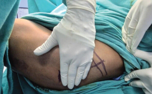 Figure 2: From the marked point (as in Figure 1), the four fingers are aligned parallel to the iliac crest. A point is then marked that indicates the precise location of the tip of the greater trochanter.