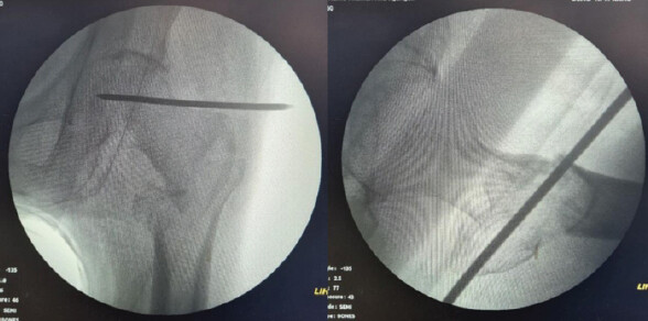 Figure 3: The marked location (as in Figure 2) was verified through fluoroscopic imaging (both anteroposterior and lateral views) using a metal marker to confirm the location of the greater trochanter tip.
