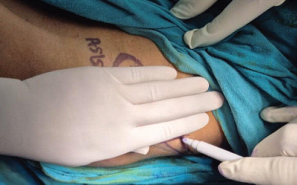 Figure 4: For surgeons with hand glove size <6.5, the anterior superior iliac spine (ASIS) is marked. The surgeon uses the width of the entire palm. From the ASIS, a point is marked on the iliac crest.