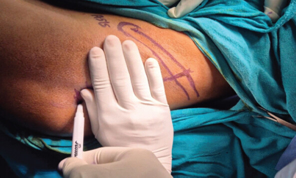 Figure 5: The palm is positioned parallel to the marked point over the iliac crest (as in Figure 4), which gives the location of the tip of the greater trochanter.