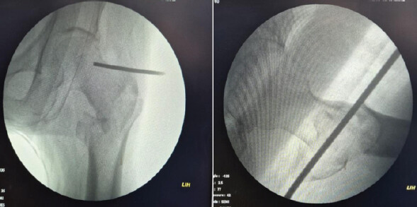 Figure 6: The marked point (as in Figure 5) is confirmed with a metallic marker using C-arm images (anteroposterior and lateral views).