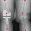 Intraoperative Proximal Fibula Fracture during Total Knee Arthroplasty for Moderate Valgus Knee Deformity: A Case Report