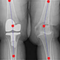 Figure 1: Pre-operative standing radiograph showing left valgus deformity and coronal alignment measurements.