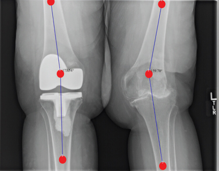 Figure 1: Pre-operative standing radiograph showing left valgus deformity and coronal alignment measurements.