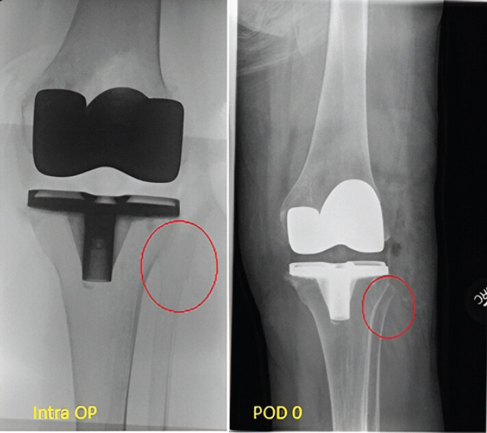 Figure 2: Intraoperative fluoroscopy and immediate post-operative radiograph showing the proximal fibula fracture.