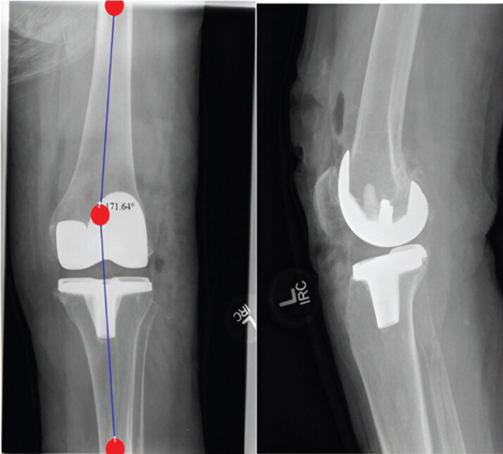 Figure 3: Two-week standing radiographs showing near-neutral post-operative alignment.