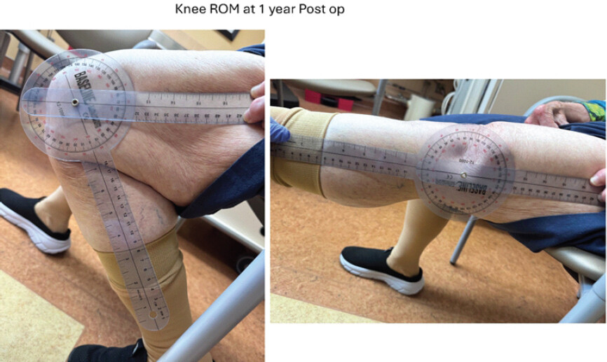 Figure 4: One-year clinical photographs showing full knee flexion and extension.
