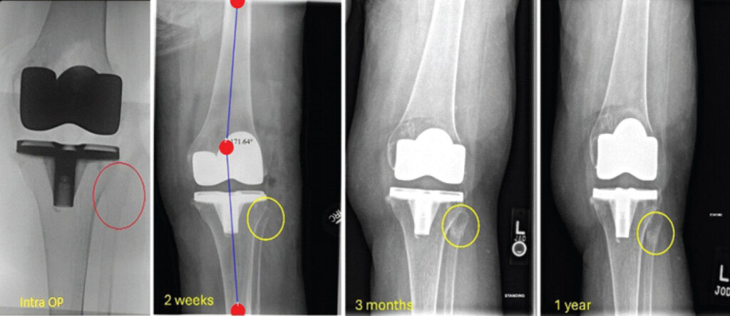 Figure 5: Serial radiographs demonstrating progressive healing of the proximal fibular fracture from intraoperative imaging through 1-year follow-up.