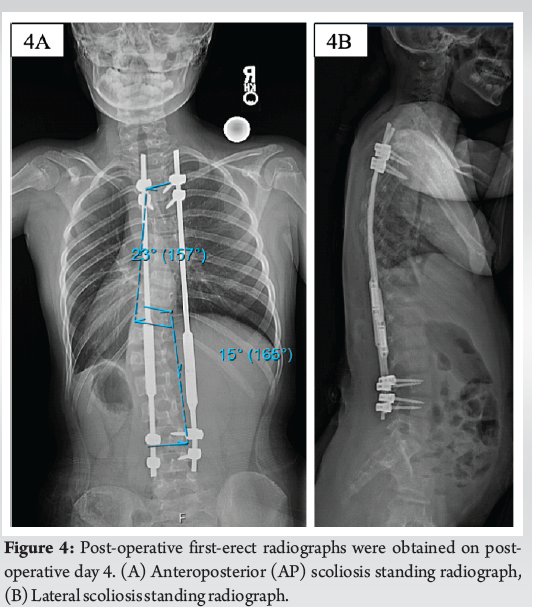Minimally Invasive Placement of Pedicle Screws Using Robotic-Assisted ...
