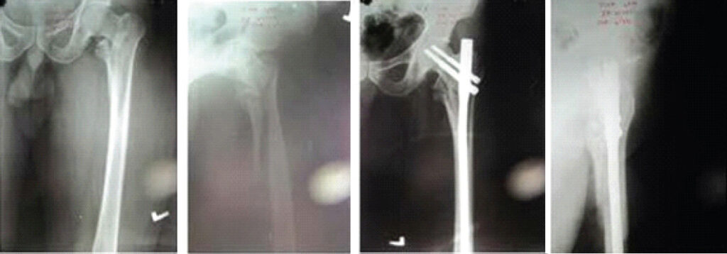 Figure 2: Case 1: Pre-operative radiographs (first two panels) and immediate post-operative radiographs after proximal femoral nailing (last two panels), read left to right across the top row, then the bottom row.