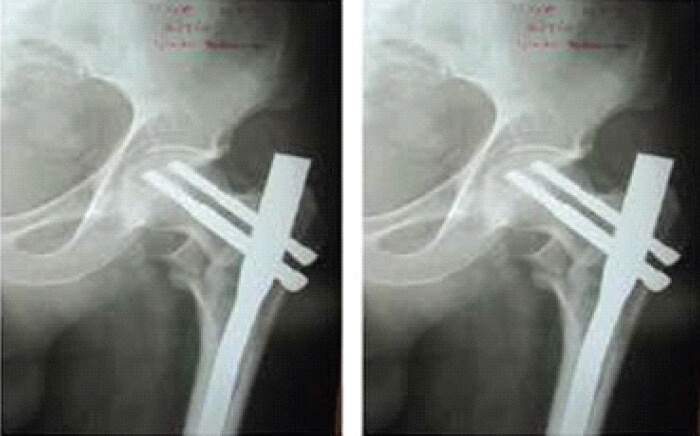 Figure 3: Case 1: Follow-up radiographs at 4 weeks (left) and 16 weeks (right).