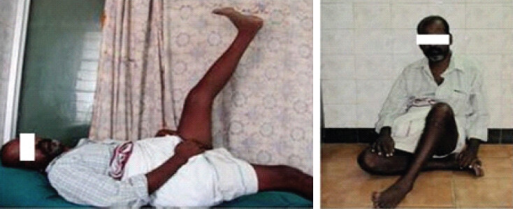 Figure 4: Case 1: Clinical photographs demonstrating active straight-leg raising (left) and cross-legged sitting (right).