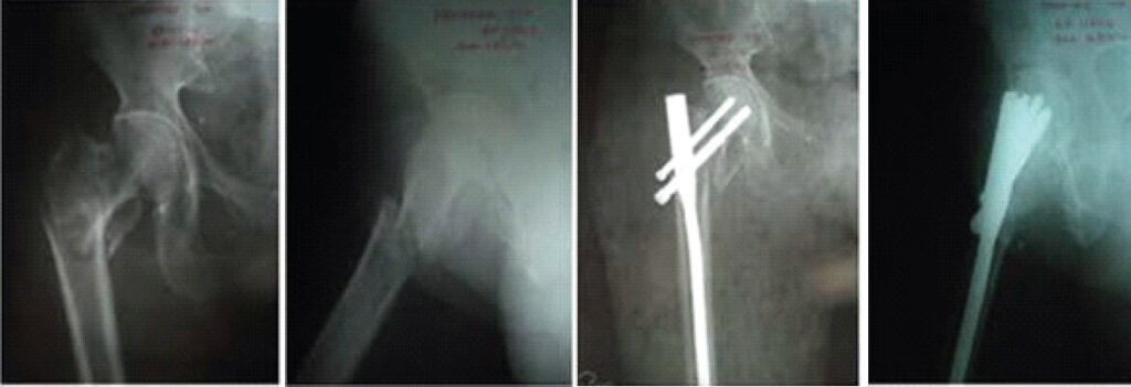 Figure 5: Case 2: Pre-operative anteroposterior and lateral radiographs (first two panels) and immediate post-operative radiographs (last two panels), reading left to right across the top row, then the bottom row.
