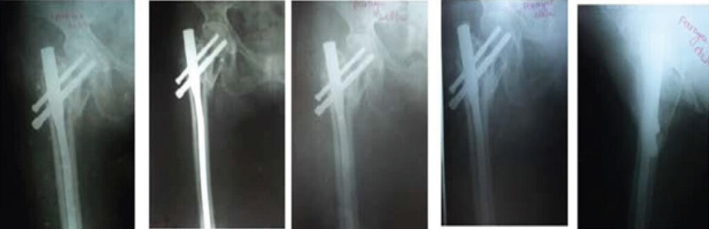 Figure 6: Case 2: Follow-up radiographs at 6 weeks, 12 weeks, 16 weeks, and 9 months (anteroposterior and lateral views), reading left to right across the top row, then the bottom row.