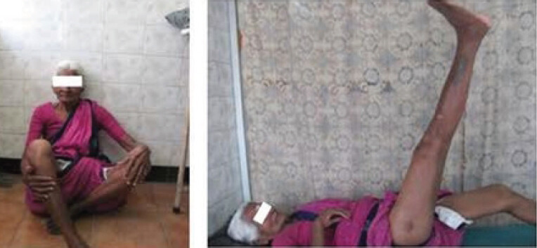 Figure 7: Case 2: Clinical photographs demonstrating squatting (left) and active straight-leg raising (right).