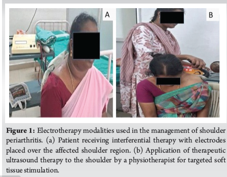 A Prospective Randomized Study Comparing the Efficacy of Electrotherapy ...