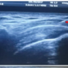A Prospective Randomized Study Comparing the Efficacy of Electrotherapy to Ultrasound – Guided Intra-Articular Steroid Injections for Frozen Shoulder