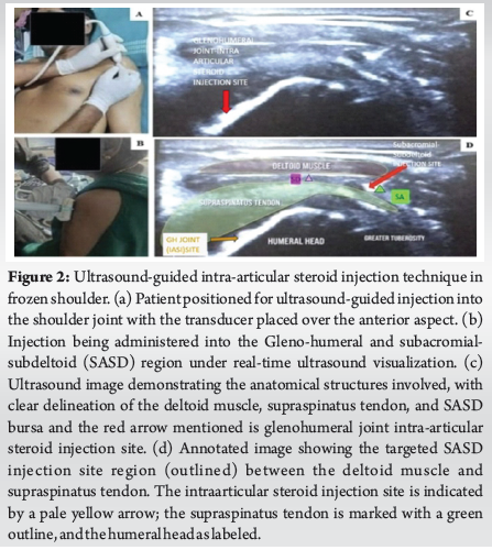A Prospective Randomized Study Comparing the Efficacy of Electrotherapy ...