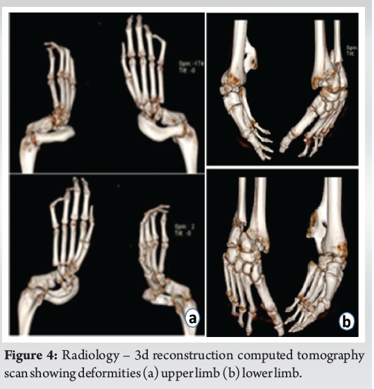 Neglected Bilateral Clubfoot Clubhand Deformity 