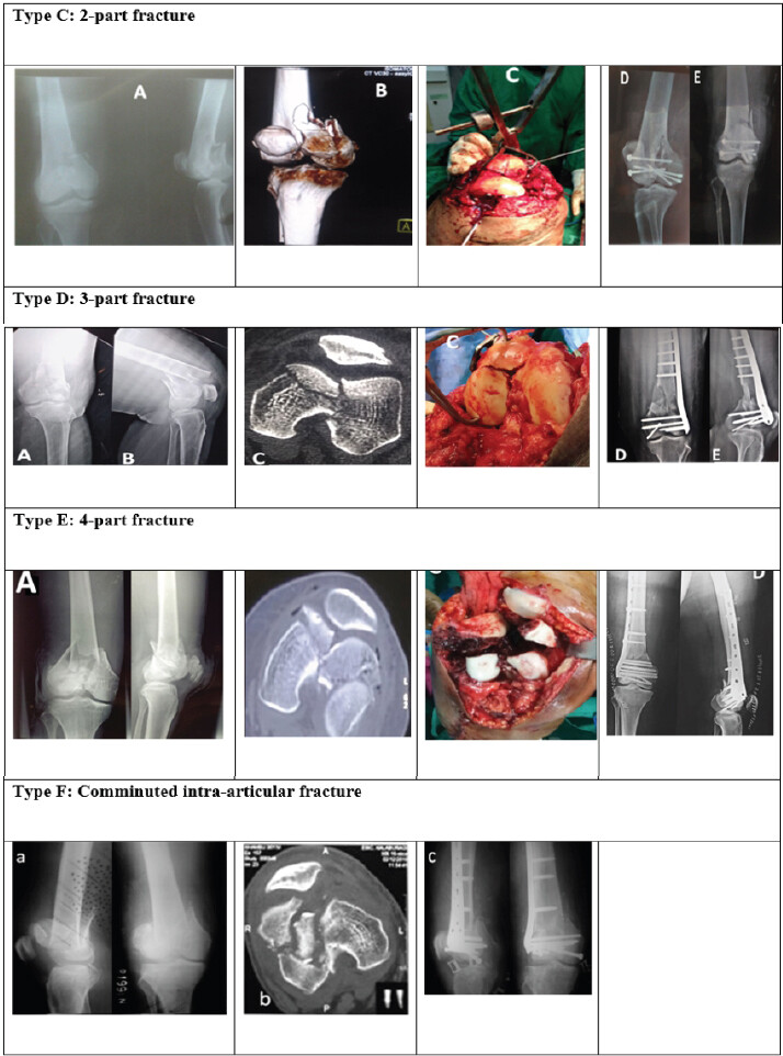 Figure 2: Radiograph, computed tomography, and clinical pictures of the proposed classification. Post-operative pictures after fixation of the fracture. (a-e) Type C: 2-part fracture, (a-e) Type D: 3-part fracture, (a-d) Type E: 4-part fracture, (a-c) Type F: Comminuted intra-articular fracture.