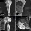 Angiomatoid Fibrous Histiocytoma in a Child with Hereditary Spherocytosis: A Rare Co-occurrence